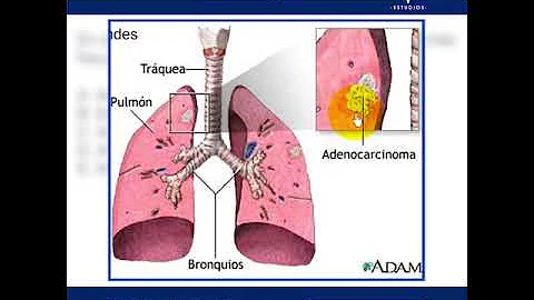 Quanto si vive con un carcinoma polmonare?