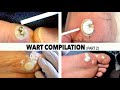 WART BURNING COMPILATION (Part 2) | Dr. Paul