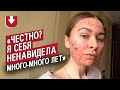 Я живу с акне: Маша | Быть молодым