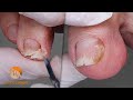 Nail trimming and control in a patient with walking difficulties (Person close to 90 years old)