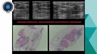 Carcinoma ductal in situ - Dr. Javier Rodriguez Lucero screenshot 3