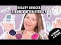 BEAUTY DEVICES BEFORE &amp; AFTERS RESULTS | ORALIFT, ZIIP, FOREO, ADURO, MYOLIFT and MEDICUBE