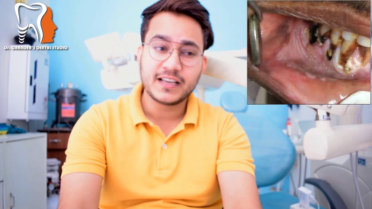 Tobacco pouch keratosis Etiology, Clinical features and Treatment