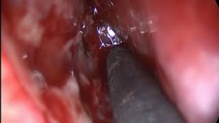 Epistaxis :Adesh Saxena; Posterior bleed middle meatus