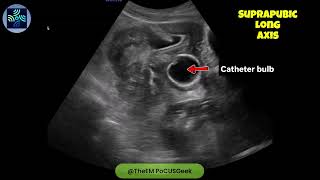 #efast Suprapubic view #bladder #calculus