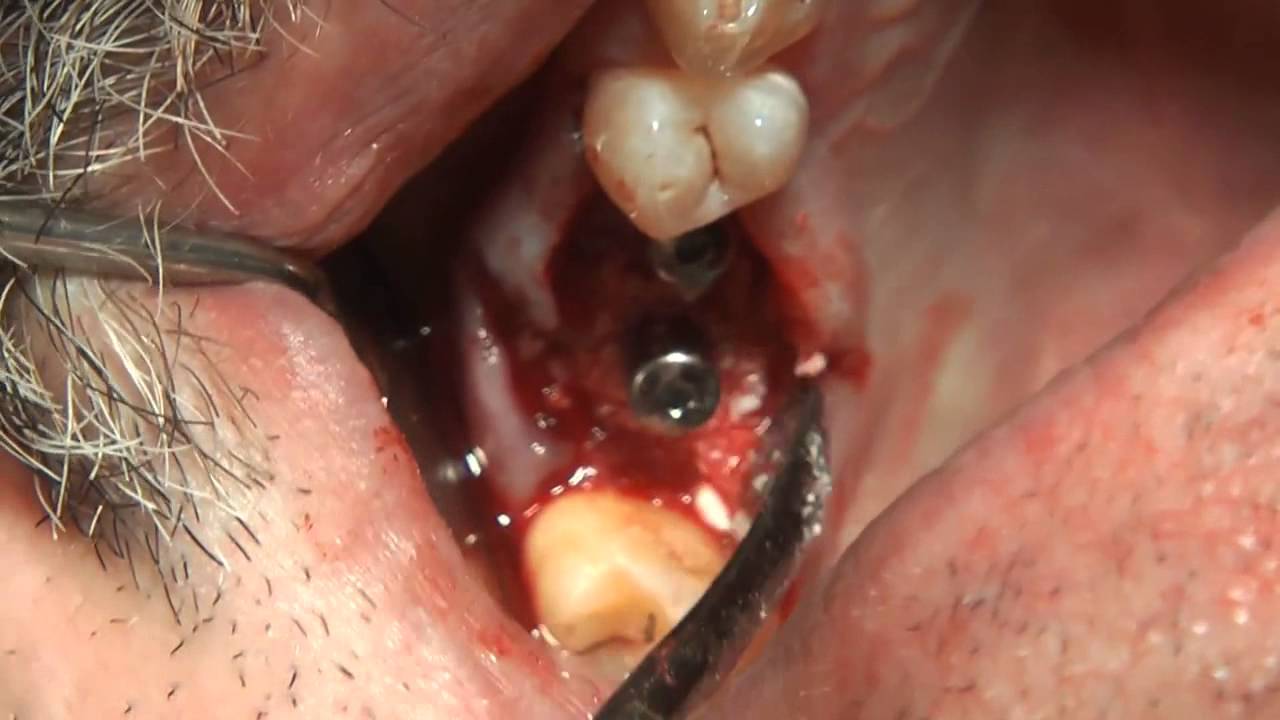 Одномоментная установка имплантата MIS SEVEN implants straumann