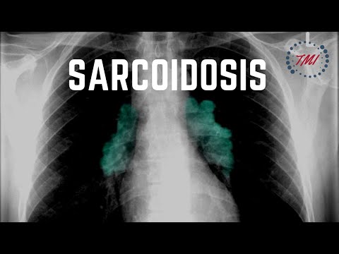 Video: ¿Quién puede contraer sarcoidosis?