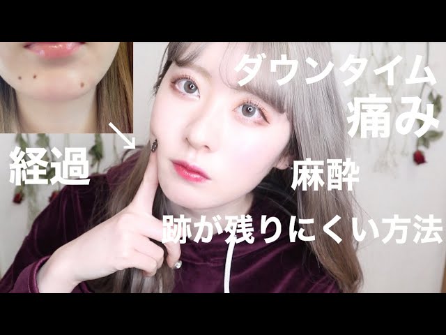 ホクロ除去 と シミ ソバカス治療 してきたよ かかった費用は 経過は By桃桃 Youtube