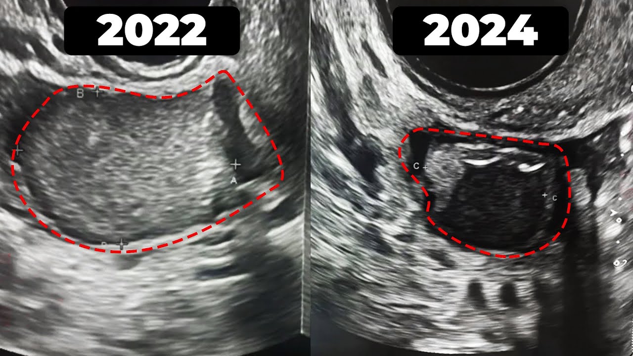 Endometriomas podem reduzir de tamanho? Saiba a resposta