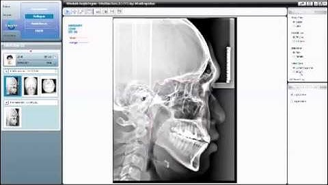 Introducing OrthoVision by Vatech