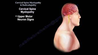 Cervical Spine Myelopathy & Radiculopathy -