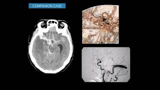 Imaging subarachnoid hemorrhage