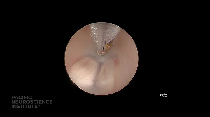 Endoscopic Third Ventriculostomy Surgery for Hydrocephalus