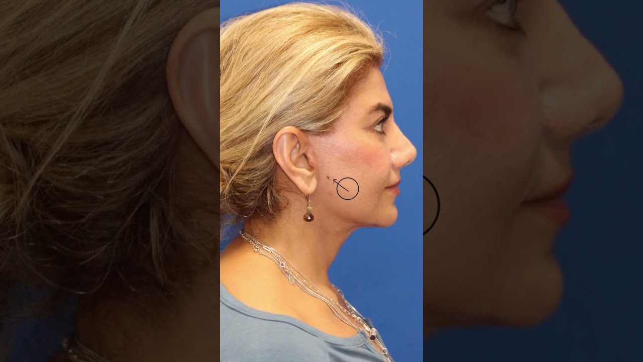 Put The LIFT In Facelift INSANE Before After Transformation 