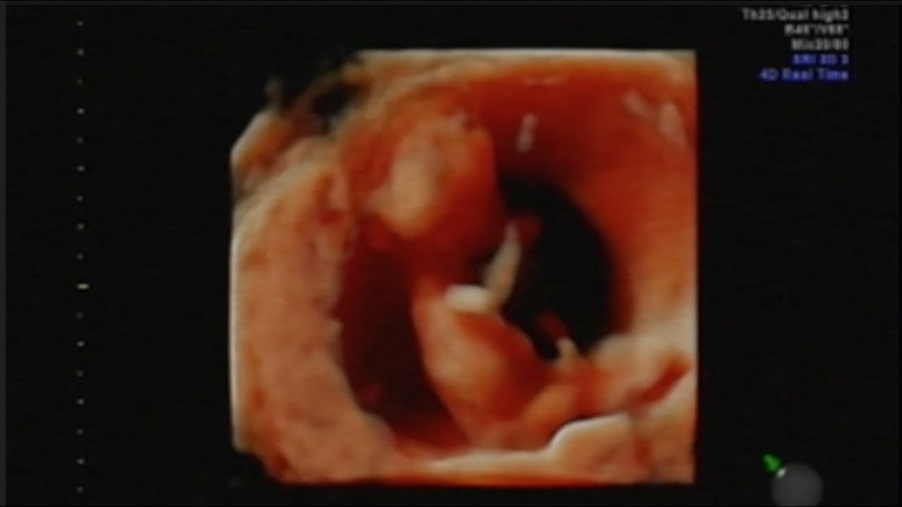 赤ちゃん 妊娠初期 12週目 の超音波エコー Youtube