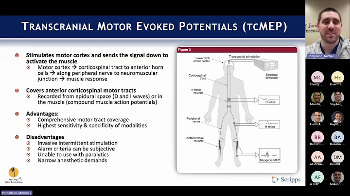 Intraoperative Neuromonitoring with Michael Pompliano, MD on March 4, 2024.
