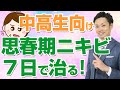 思春期ニキビを治す方法☆中学生、高校生はこの対策で! (道山ケイ)