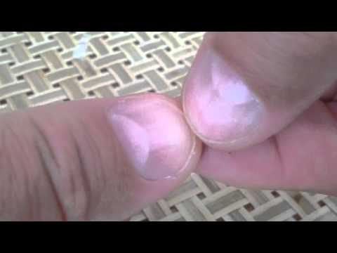 diabetic-?-quick-fingernail-test-for-diabetes