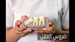 ELWASFA | طريقة التعامل مع ضرس العقل المدفون مع الدكتور هشام الهواري