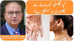 Leukoderma Treatment and Cure in Lahore, Pakistan