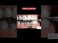 Think Your Teeth Are Clean? 🦷 Look Closer! #Shorts #Dental #dentaltips #animation