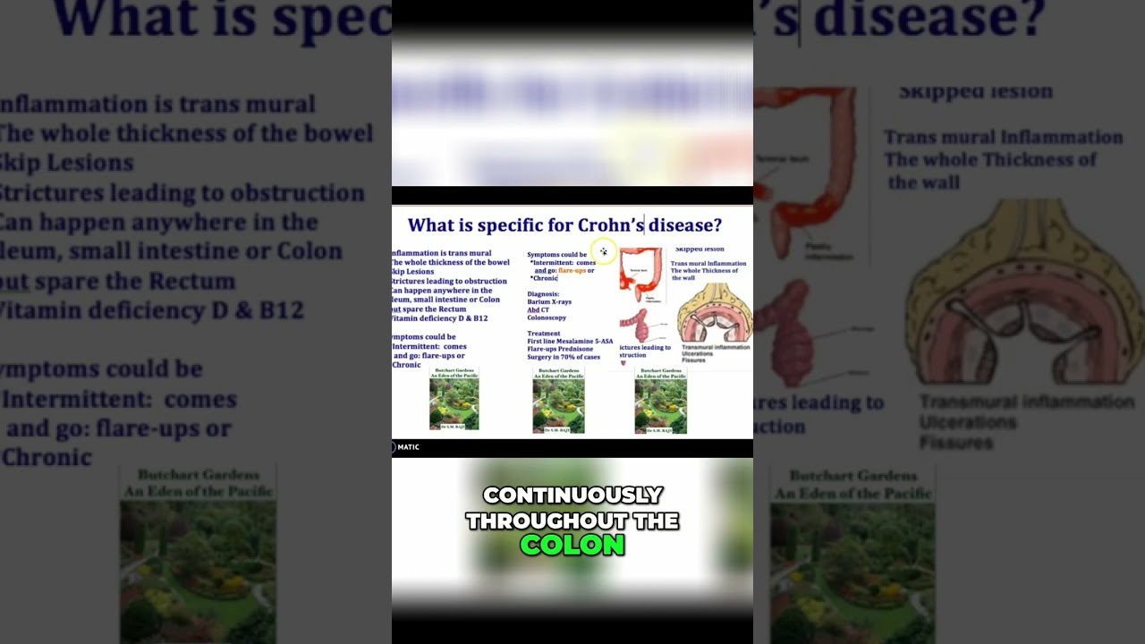 2-Minute Mesalamine (Pentasa) ER capsules for ulcerative colitis 