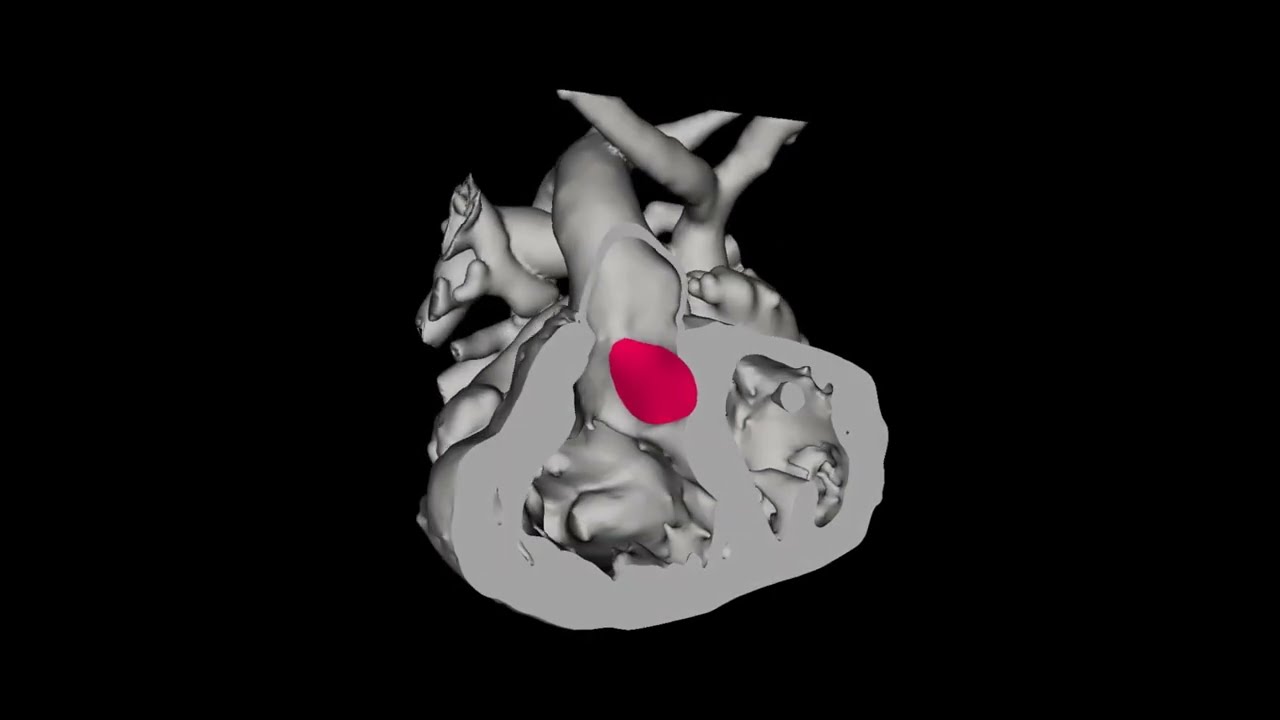 SlicerHeart Baffle Planner for Surgical Planning of Patient with DORV, Pulmonary Stenosis, and VSD