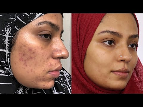 MY ACNE STORY - WHAT FINALLY WORKED??