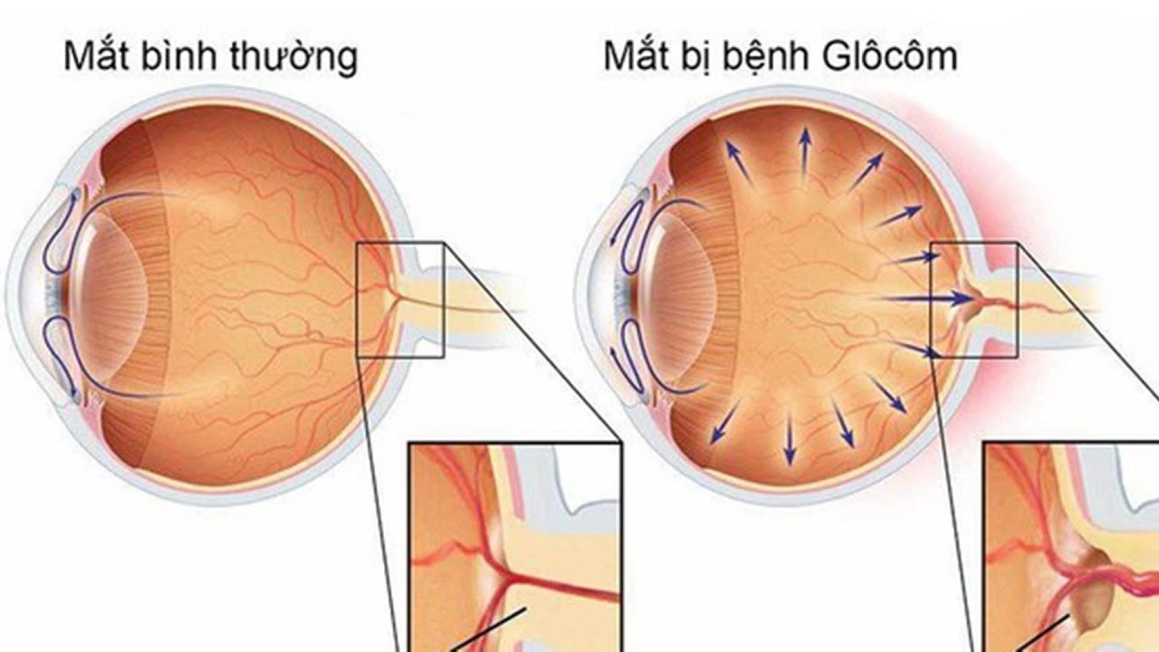 Зрительный нерв при глаукоме. Нормотензивная глаукома. Глаукома 2 экскавация. Глаукома норма внутриглазного давления. Повреждение зрительного нерва при глаукоме.