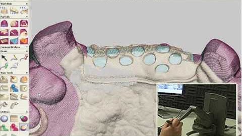 Introduction to Removable Partial Denture Design