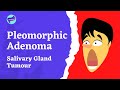 Pleomorphic Adenoma-Salivary Gland Tumour. Facts & Features. #tmj #dentalstudent #dentalhygiene