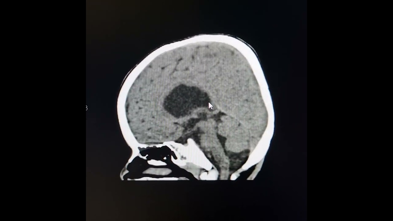 Porencephalic cysts.