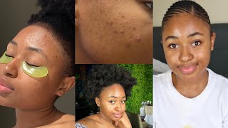 Story time - How I cleared my recent acne breakout | My current skincare routine | with photos