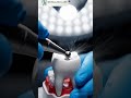 Root Canal Treatment and Restoration 🦷 #satisfying #dentistry #shorts