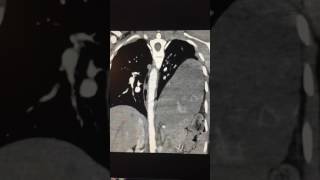 CT chest screenshot 5