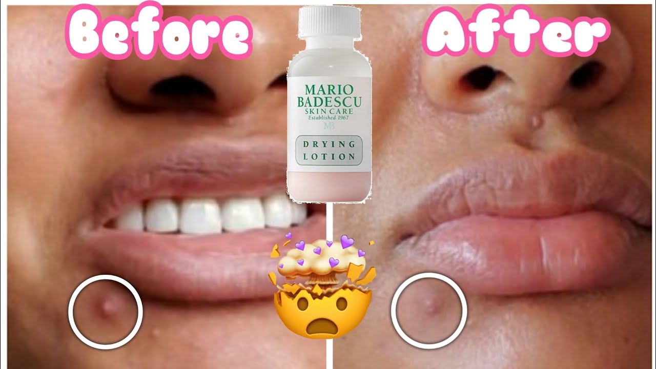 ligning løfte Forblive Mario Badescu Drying Lotion First Impressions and Review! - YouTube