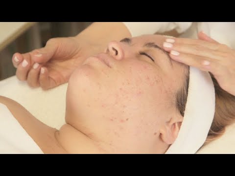 Diet Related Acne And Facial With Alessandra