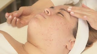 Diet Related Acne And Facial With Alessandra