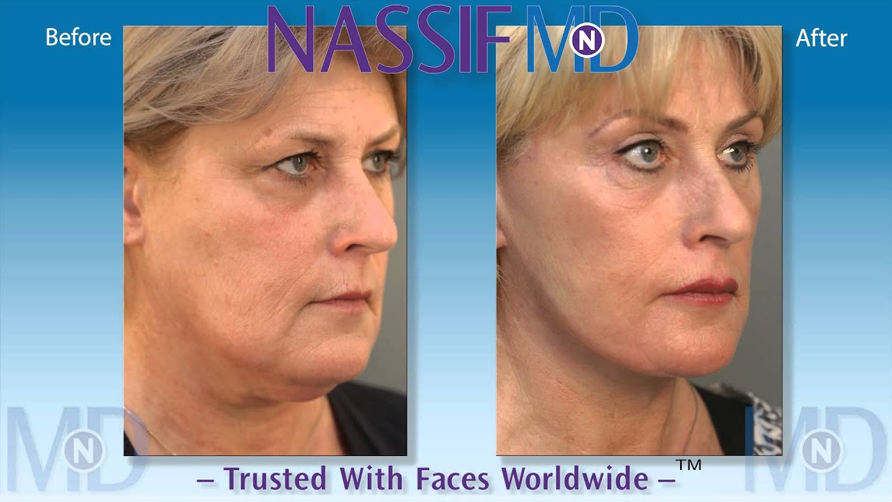 Facelift Patient Experience Janice Dr Nassif Youtube 