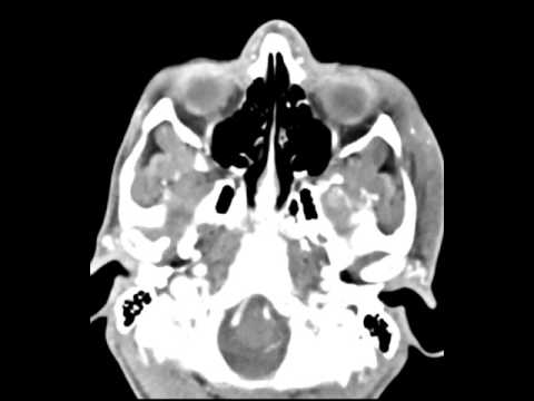 Video: Gambaran Histopatologis Hiperplasia Condylar Dan Osteochondroma Condylar: Studi Perbandingan