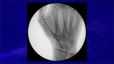 Volar Percutaneous Scaphoid Fracture Fixation