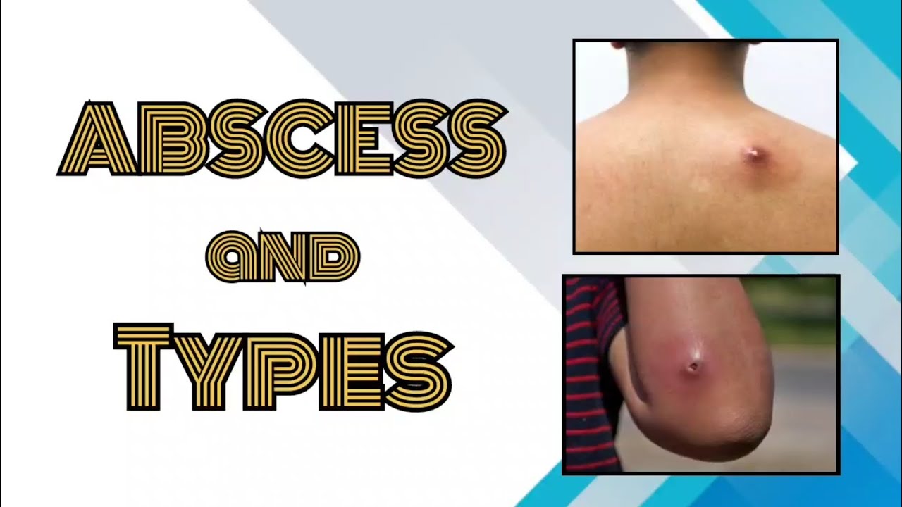// ABSCESS & TYPES SURGERY// Abscess Treatment at Home, Abscess