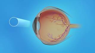 Cystoid Macular Edema: Medication Injections