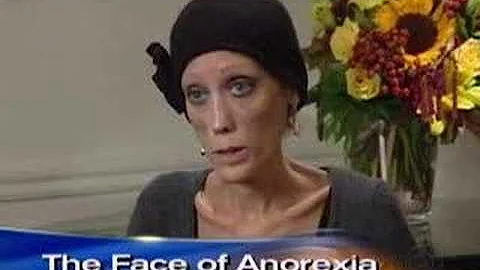 Anorexia's Living Face (CBS News)
