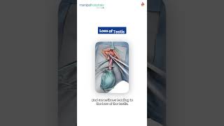 Testicular Torsion Emergency | Dr. Amit B. | Manipal Hospital Yelahanka