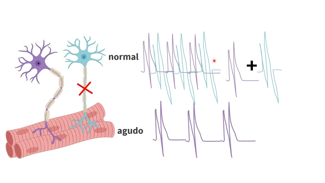 Electromiograma en esclerosis lateral amiotrófica