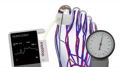 How to Measure the Toe Pressure Index (TBI)