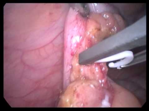 Lap Appendectomy (unedited-26)-Simple Recurrent Appendicitis With Hemorrhagic Ovarian Cyst