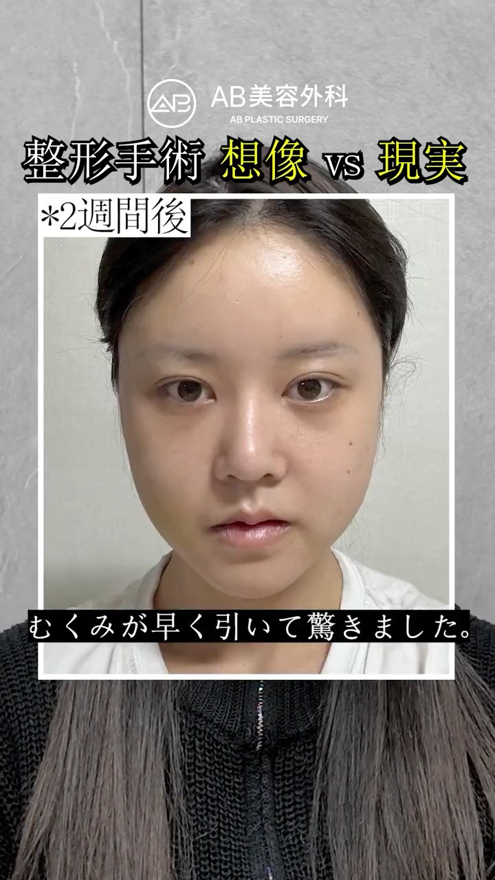 まだ腫れてるけど…両顎手術1ヶ月のリアル #shorts