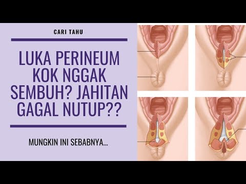 Video: Apakah jahitan perineum seharusnya berdarah?